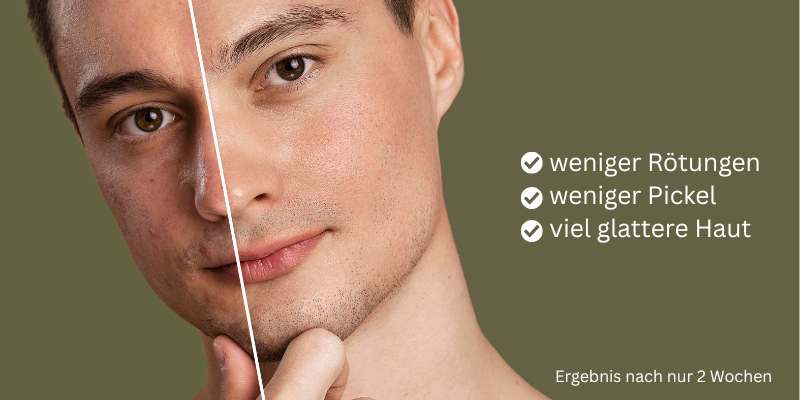 David nach 2 Wochen HOCL-Behandlung - deutliche Verbesserung der Haut